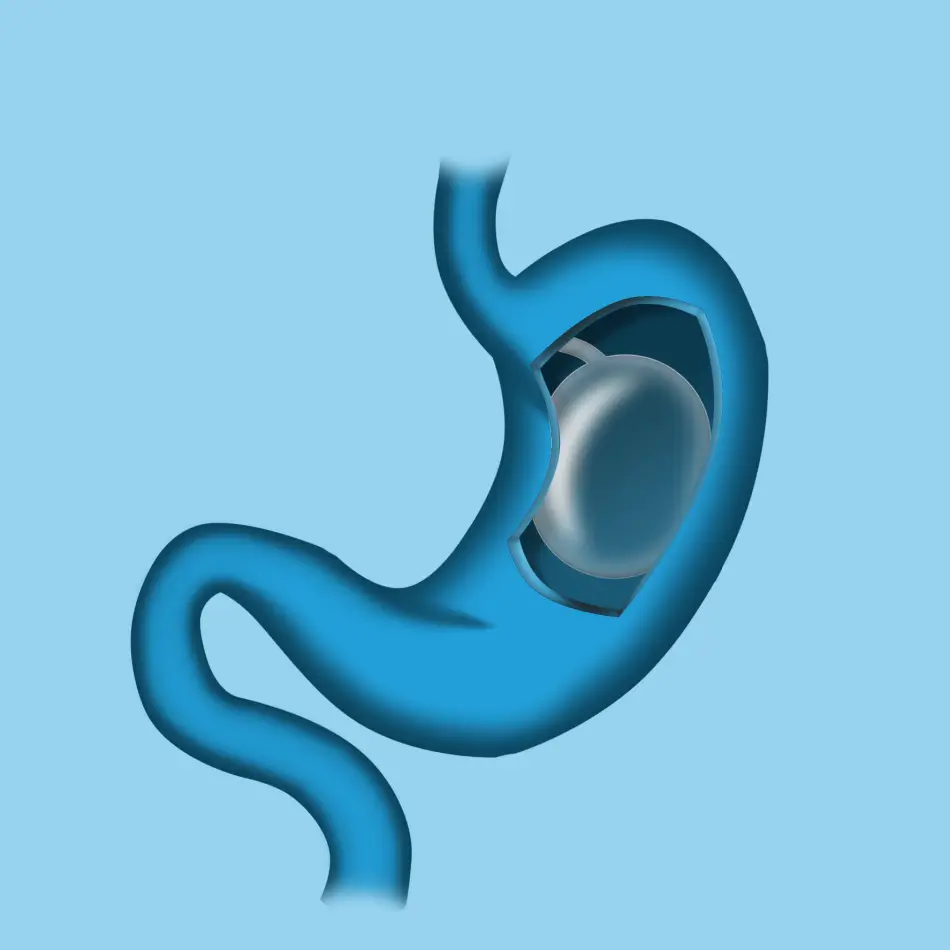 Gastric Balloon